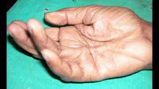 Dupuytrens Contracture Case discussion Podcast  Part 1 [upl. by Rivy318]