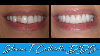 No Tooth Prep Veneers vs Tooth Prep Veneers  Dental Minute with Steven T Cutbirth DDS [upl. by Linell689]