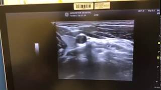 Cervical Sympathetic Chain Stellate Ganglion Block using Ultrasound [upl. by Darcia]