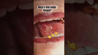 Canker sore Ulcers Tongue oralhealth viral fashion smile youtubeshorts trending shorts fyp [upl. by Ecnerwal]