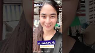 Chartier รีวิวโปรแกรมโบท็อกซ์ คลินิกเสริมความงาม [upl. by Cheslie401]