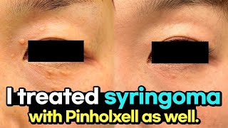 Successfully treated recurring syringomas resistant to laser treatment using Pinholxell method [upl. by Nelia]