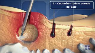 EPSIT Endoscopic Pilonidal Sinus Treatment  Tratamento Endoscópico do Cisto Pilonidal [upl. by Levona]