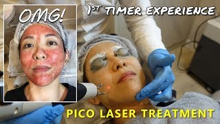 PICO Laser Treatment  1st Timers Experience  Kat L [upl. by Einomrah700]