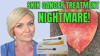 THE UGLY TRUTH ABOUT SKIN CANCER My Fluorouracil Treatment Journey [upl. by Caassi162]