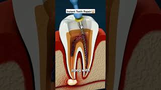 Damaged Tooth Repair Entire Process shorts viral [upl. by Elorak]