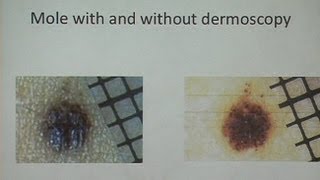 Melanoma and Nonmelanoma Skin Cancer [upl. by Zack493]