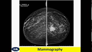 Invasive ductal carcinoma breast cancer [upl. by Fia]