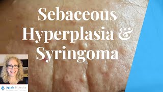 SEBACEOUS HYPERPLASIA VS SYRINGOMA  BEST REMOVAL PROCEDURES [upl. by Teryl]