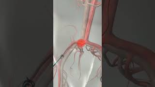 Learn How Cardiac Catheterization Works [upl. by Hartman]