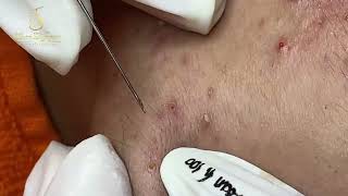 Loan Nguyen Acne Treatment 27b [upl. by Min]