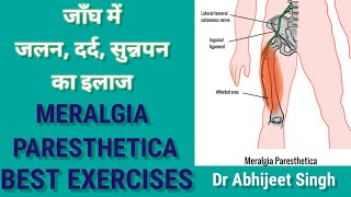 MERALGIA PARESTHETICA TREATMENT IN HINDI  OUTER THIGH NUMBNESS AND TINGLING TREATMENT EXERCISES [upl. by Kevin]