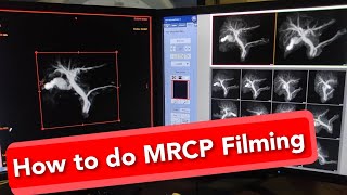 MRCP MRI scan Filming Protocol [upl. by Harelda364]