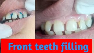 front teeth cavity fillings [upl. by Maitland]