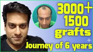 Hair Transplantation Result in 6 Years 4500 DHTFUE grafts NW 34 at 6 years Drs SethiBansal [upl. by Lubow]