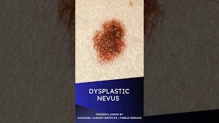 Dysplastic Nevus [upl. by Tatiania485]