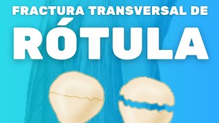 FRACTURA TRANSVERSAL DE RÓTULA [upl. by Oribelle]