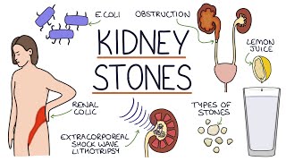 Understanding Kidney Stones [upl. by Liebermann]