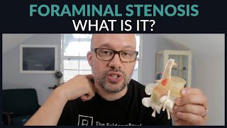 What is Foraminal Stenosis [upl. by Elades]