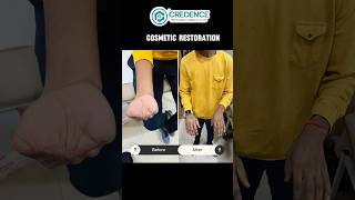 🤯😲 Nakli Hath  Silicone Cosmetic Restoration  Artificial Hand  amputation amputee shorts [upl. by Sirronal]