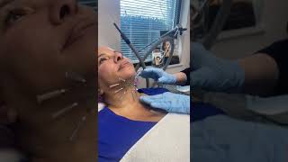 PDO Threads to tighten and lift neck  nonsurgical neck lift by Dr Pamela Kulback [upl. by Annaej559]