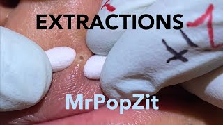 Acne ExtractionsBlackheads for days 5 Nothing but the popCreamy pore pops Blackheadswhiteheads [upl. by Sivad]