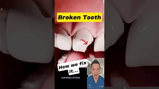 Broken Front Tooth Here’s How Dentists Restore Your Smile dentallan dentist shorts [upl. by Llenrahc]