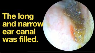 The long and narrow ear canal was filledear wax removal  ear cleaning  ASMR  relaxation  relax [upl. by Alfredo]