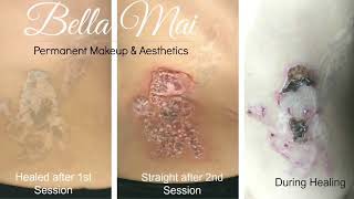 Salt and Saline Body Tattoo Removal 2 Treatments and Healing Process HIGHLY ASKED FOR VIDEO [upl. by Aimac19]