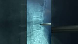 شرح عام عن Lumbosacral Spine XRay و توضيح الانزلاق الفقري  الدكتور محمد مجذاب الربيعي [upl. by Goulet]