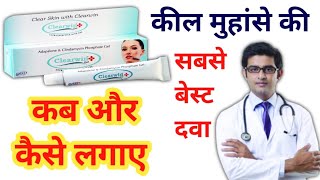 Blackhead removal pimples removal clearwin plus gel acne treatment  clearwin gel use in hindi [upl. by Eentruok]