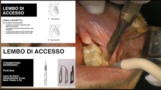 Lestrazione del dente del giudizio step by step [upl. by Amliw]