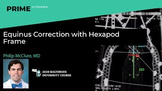 Equinus Correction with Hexapod Frame  Philip McClure MD [upl. by Talie]