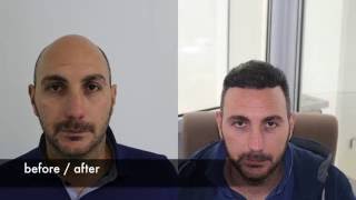 Hair transplant before after FUE Hair transplant [upl. by Slaby]