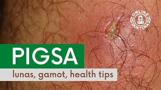 PIGSA Lunas Gamot at Health Tips  Anong Dapat Gawin Kapag May Pigsa o Boil [upl. by Ettennaj]