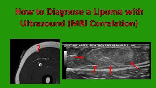 Lipoma Ultrasound Characteristics Updated 2020 [upl. by Ecissej]