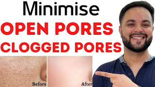 Open PoresClogged Pores amp Enlarged Pores Solution with Home Remedies [upl. by Ttevy]