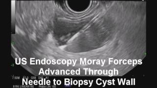 Biopsy using US Endoscopy Moray Forceps of Indeterminate Pancreas Cyst via EUSFNA [upl. by Philip]