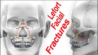 Lefort 13 Upper Jaw MidFace Facial Fractures [upl. by Mellette]