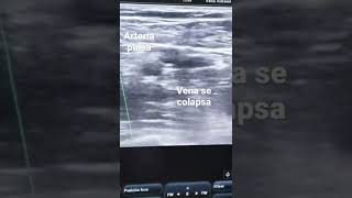 Ultrasonido Doppler  Diferencia entre vena y arteria [upl. by Lucius525]