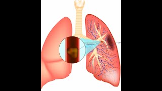 Pulmonary Embolism [upl. by Adiesirb693]