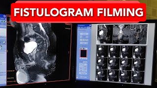 Fistulogram MRI scan Filming Technique [upl. by Ardnat593]