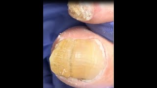 Trimming the toenails that are deformed thickened and yellowed due to fungus fungustoenail [upl. by Irok256]