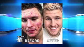 How One Man Defeated His Cystic Acne through Changing What He Ate [upl. by Nolly]