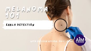 Early Detection of Melanoma [upl. by Thomey]