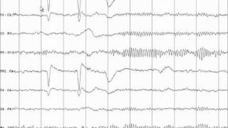 EEG Tutorial [upl. by Rajewski]