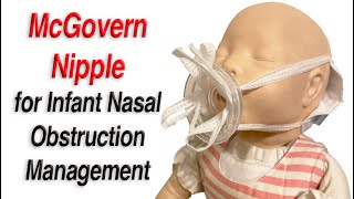 McGovern Nipple to Manage Infant Nasal Obstruction [upl. by Braca]