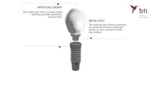 What are dental Implants [upl. by Jerol166]