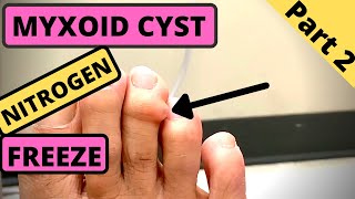 Bump on my toe Myxoid Cyst gets Nitrogen Freeze Part 2 [upl. by Ahsika990]