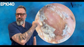 Removing Infected Ear Wax A Relief Like No Other  EP1040 [upl. by Esiuolyram]